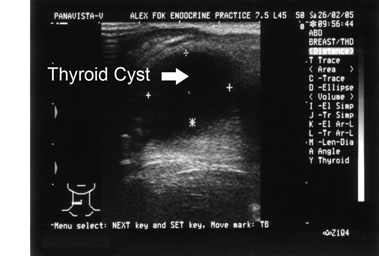 us_Cyst